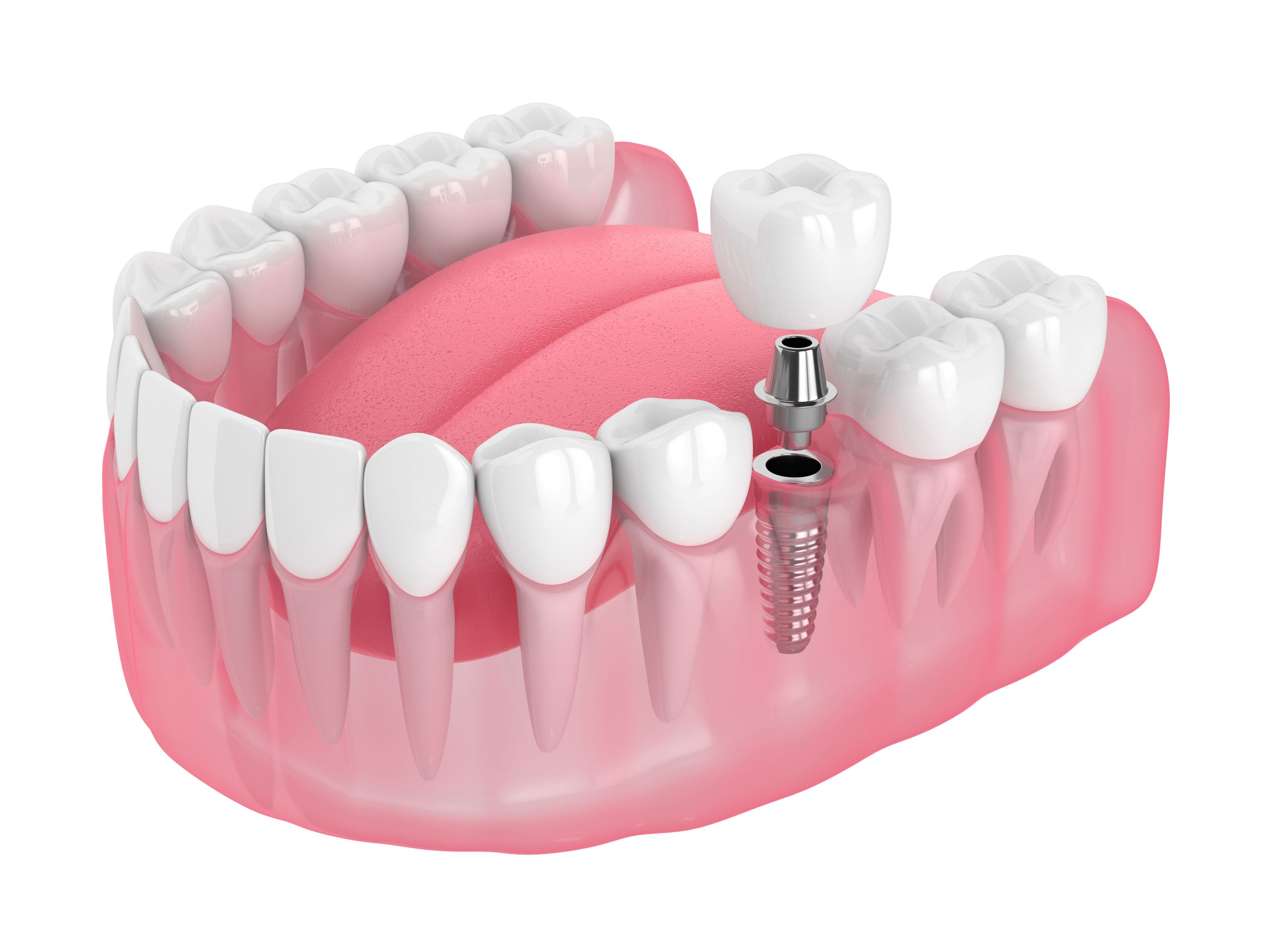 3d-render-of-jaw-with-dental-implant---AdobeStock_272264354