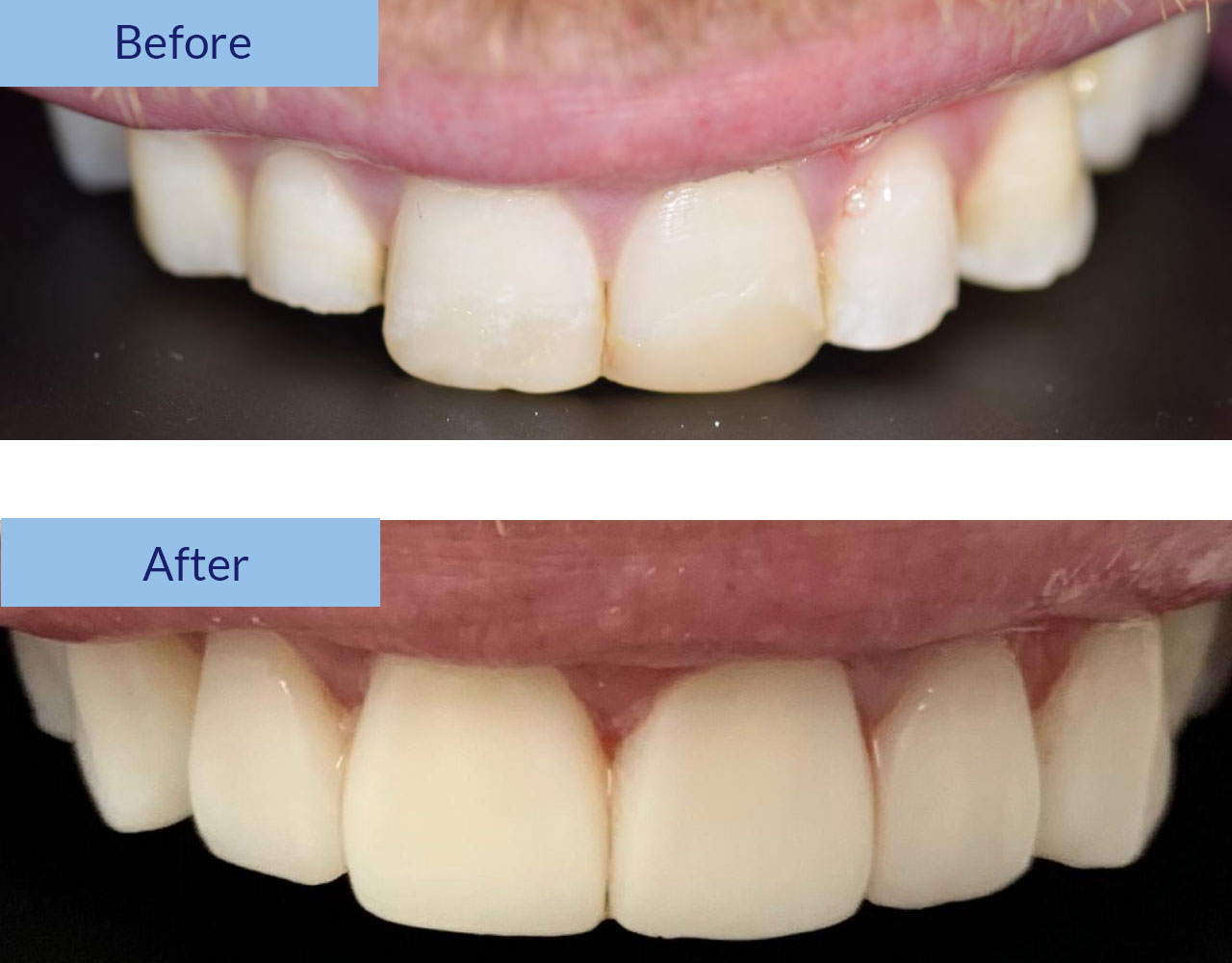 Before and After Composite Bonding