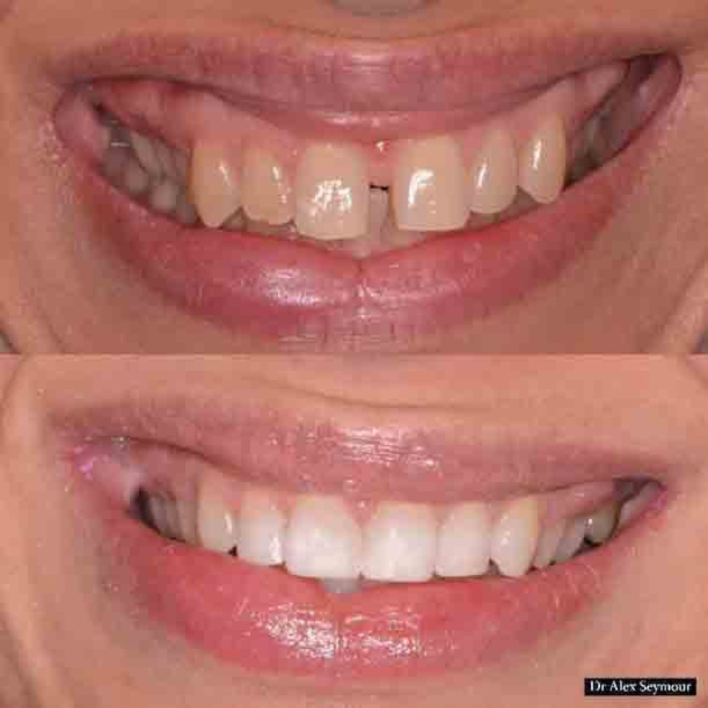 before and after invisalign, whitening and composite bonding