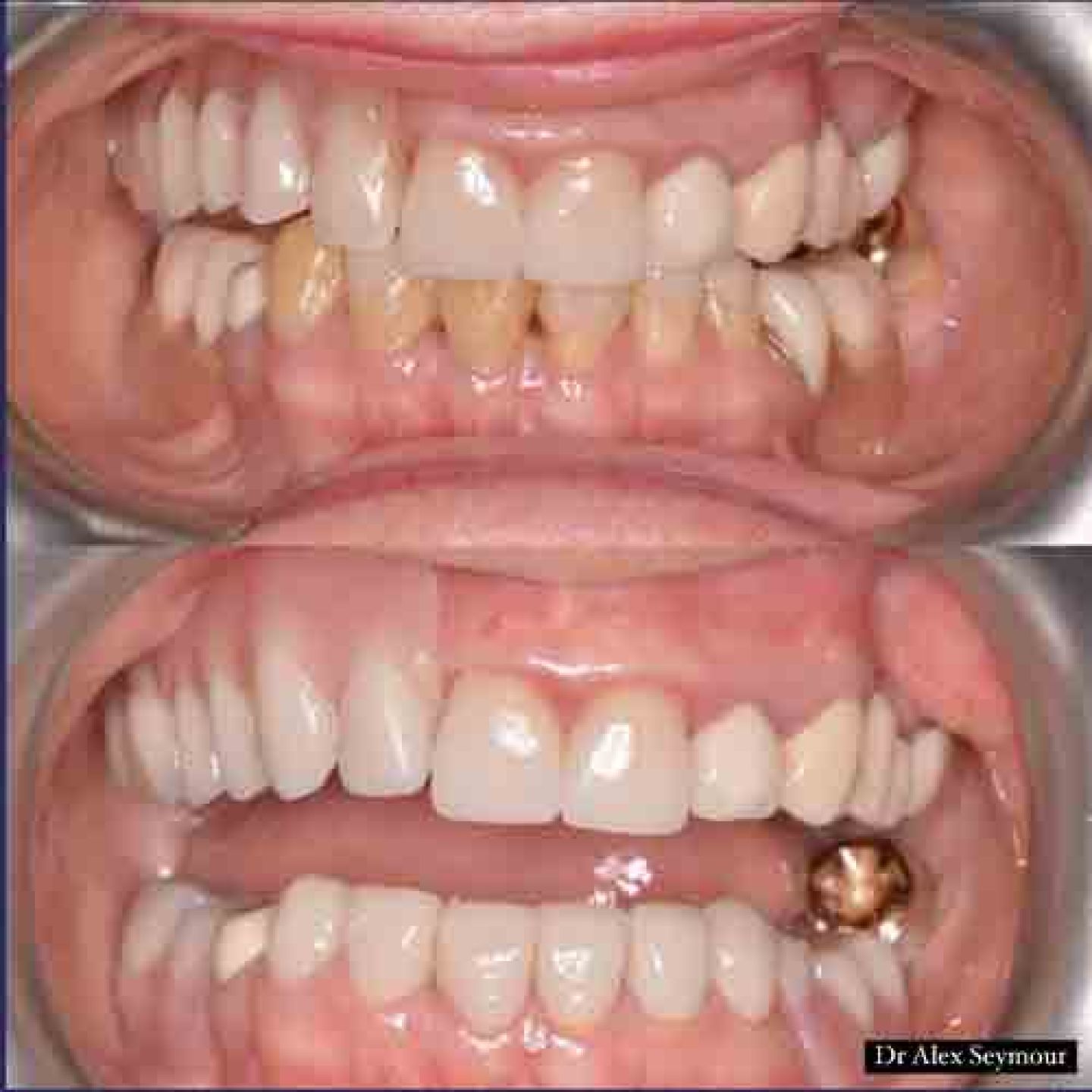 x6 lower crowns and a new upper partial denture