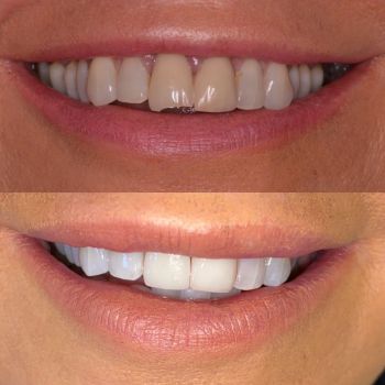 before and after photo of a patient who has undergone teeth whitening and then had two porcelain veneers placed on her upper front two teeth.