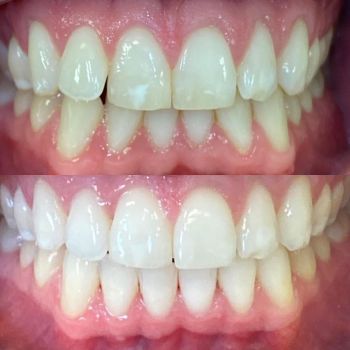 Before and after invisalign and whitening (1 of 3)