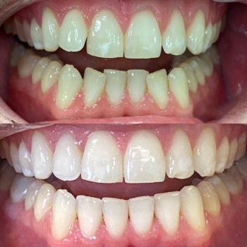 Before and after invisalign and whitening (2 of 3)