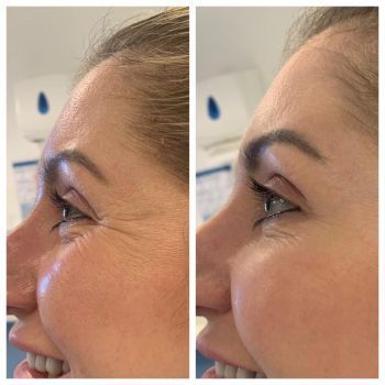 Before and After 3 Crows Feet Botox