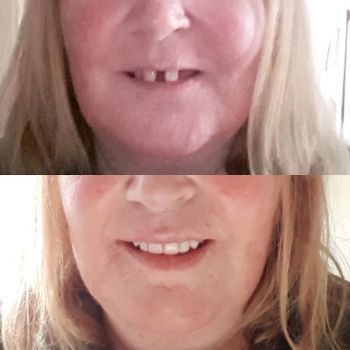 before and after implant denture
