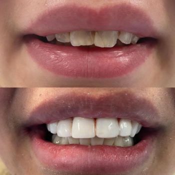 before and after whitening and composite veneer