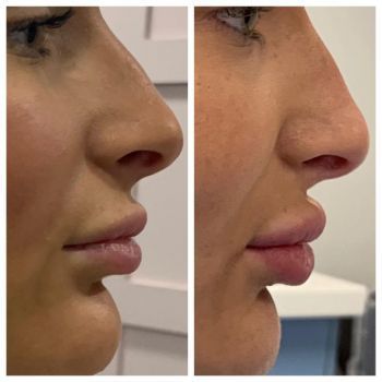 lip fillers before and after1