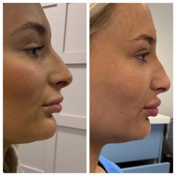 lip fillers before and after2