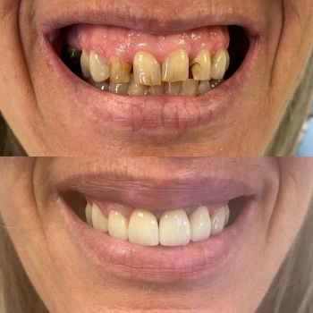 before and after veneers 1