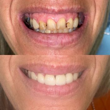 before and after veneers 2