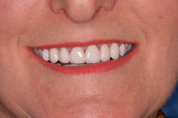 After teeth whitening, x2 crowns and x6 porcelain veneers