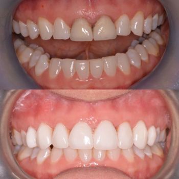 Before and after  teeth whitening, x2 crowns and x6 porcelain veneers 1