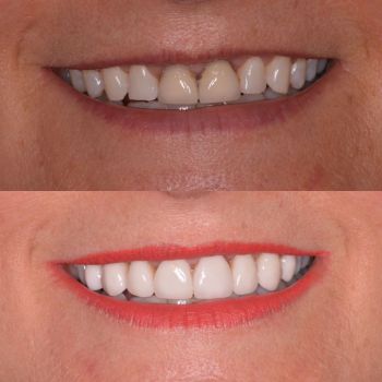 Before and after teeth whitening, x2 crowns and x6 porcelain veneers 2