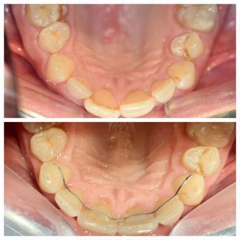 before and after ortho 2