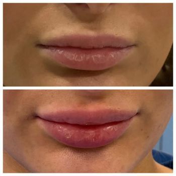 lip fillers before and after3